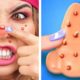Don’t touch the PIMPLES *Amazing GADGETS from Tik Tok*