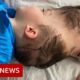 Conjoined twins separated with the help of virtual reality - BBC News